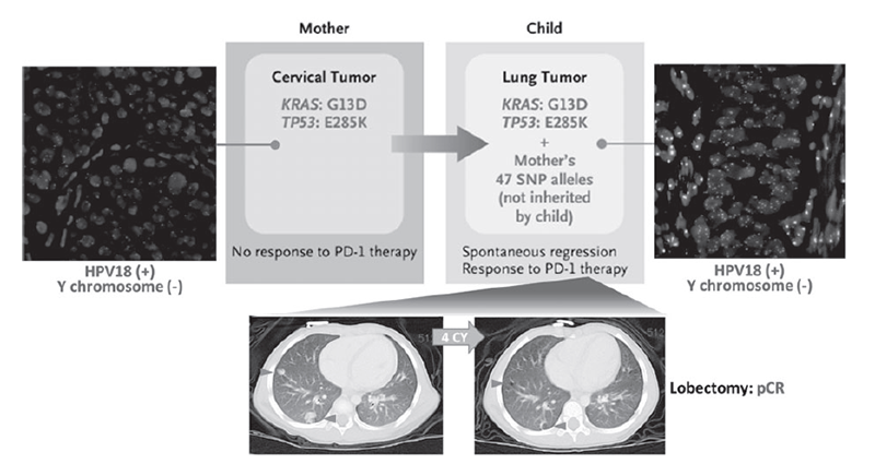 Figure 1. Immune checkpoint blockade therapy for cervical cancer transmitted from mother to infant