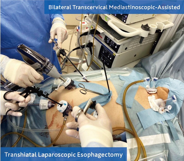 図4. 縦隔鏡下食道切除（Bilateral Transcervical Mediastinoscopic-Assisted, Transhiatal Laparoscopic Esophagectomy）画像