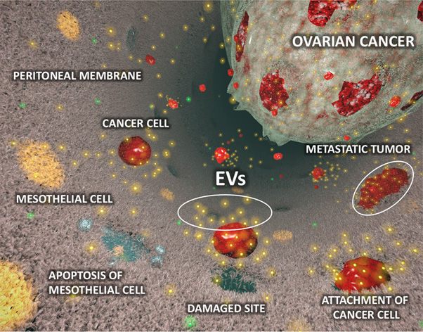 Figure: The diagram of peritoneal dissemination involved in extracellular vesicles (EVs) derived from ovarian cancer cells
