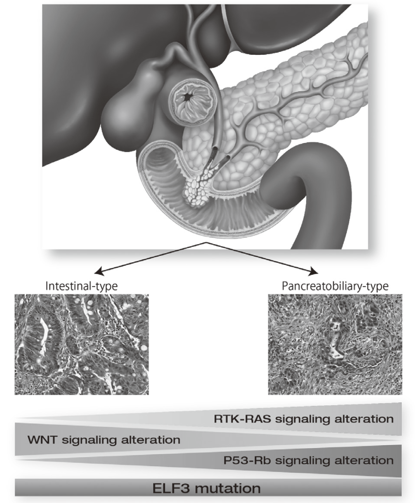 Figure 1. Genetic landscape of ampullary carcinomas(Full Size)