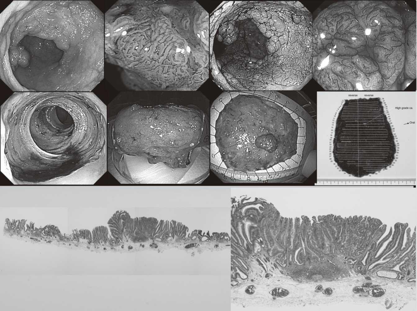 Figure 1. Endoscopic diagnosis using image-enhanced endoscopy (high-resolution endoscopy, narrow-band imaging and chromoscopy) and endoscopic submucosal dissection (ESD) procedure for treating early colon cancer(Full Size)