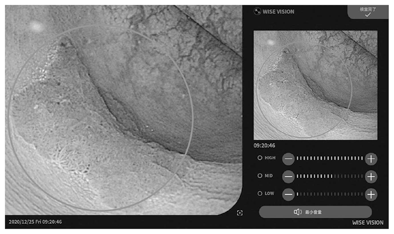 Figure 2. Example of colorectal cancer detection using the endoscopic AI system.