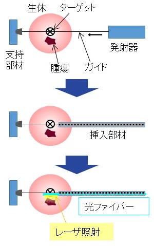 新規穿刺焼却デバイスの特徴（特願2017-508444）図