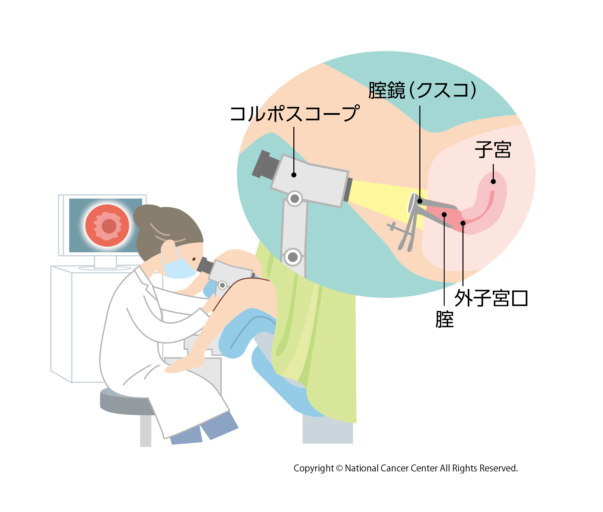 コルポスコピー（腟拡大鏡診）