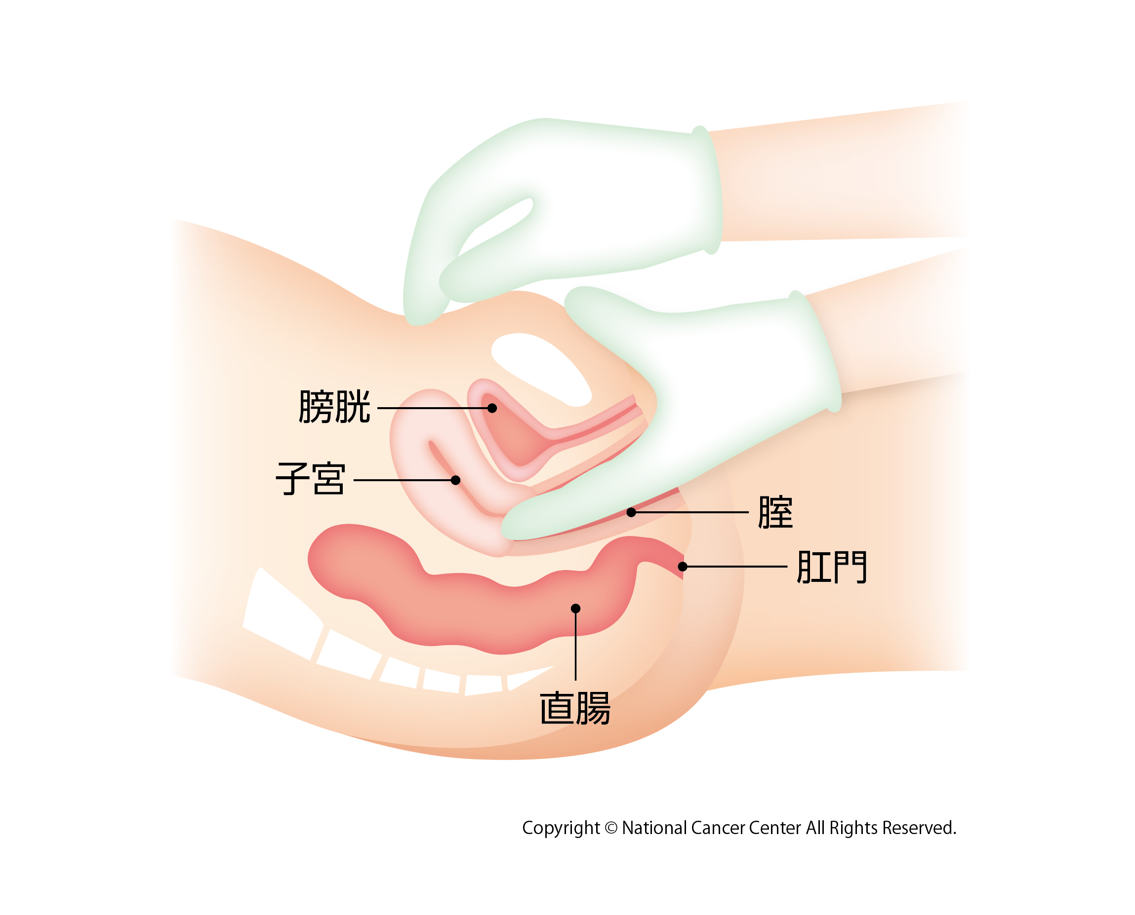 子宮頸がん　内診