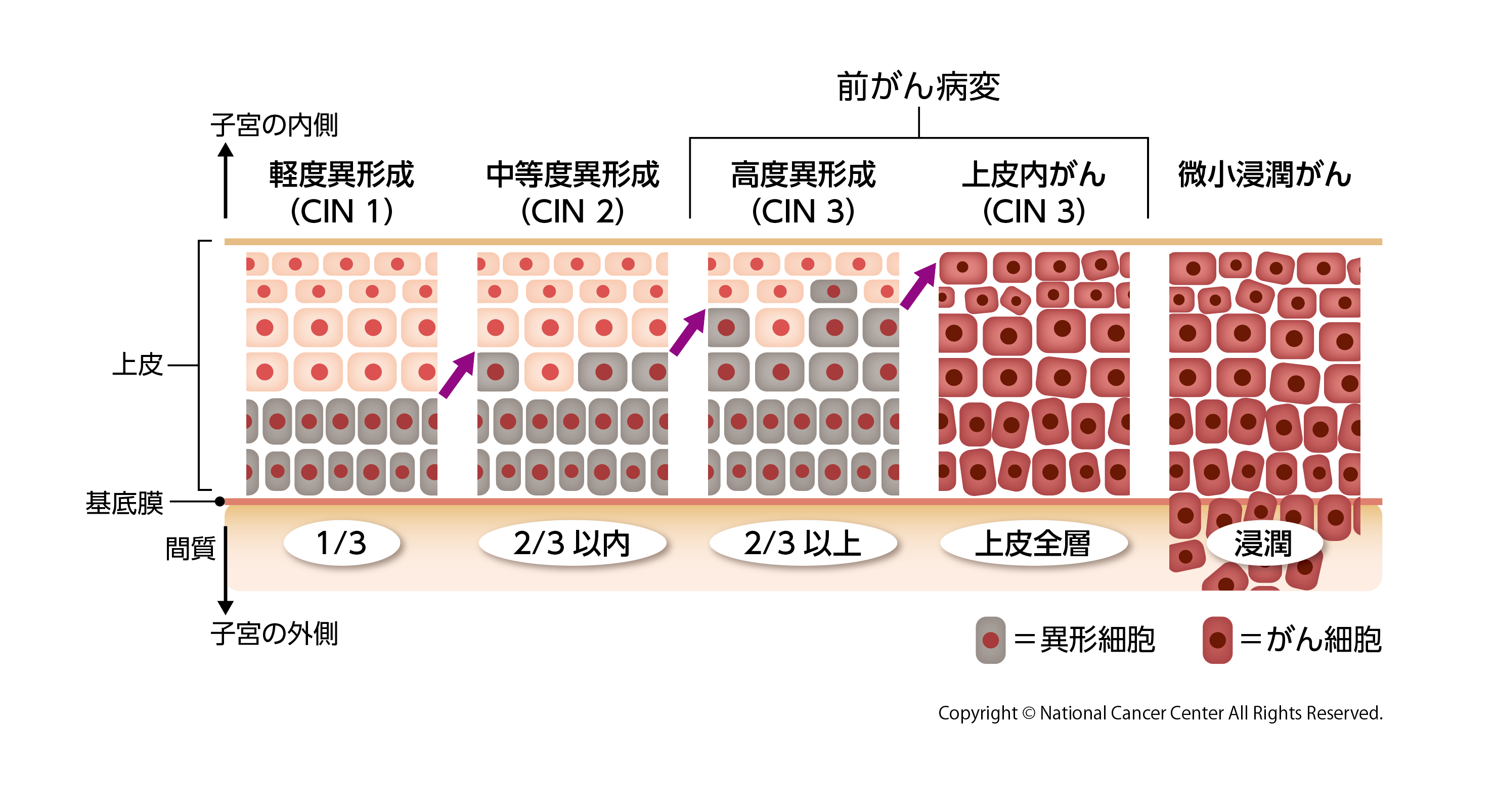 子宮頸がんの前がん病変の進行