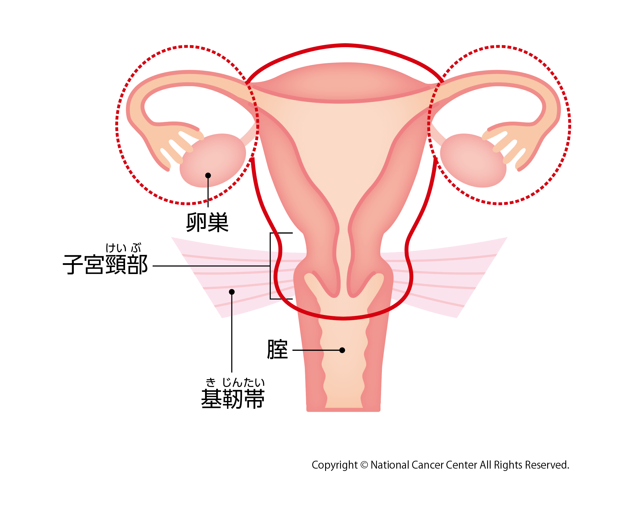 準広汎子宮摘出術