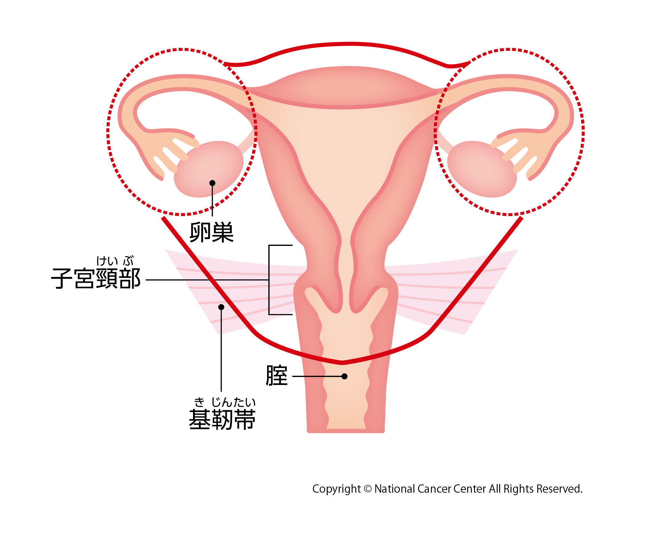 広汎子宮全摘出術