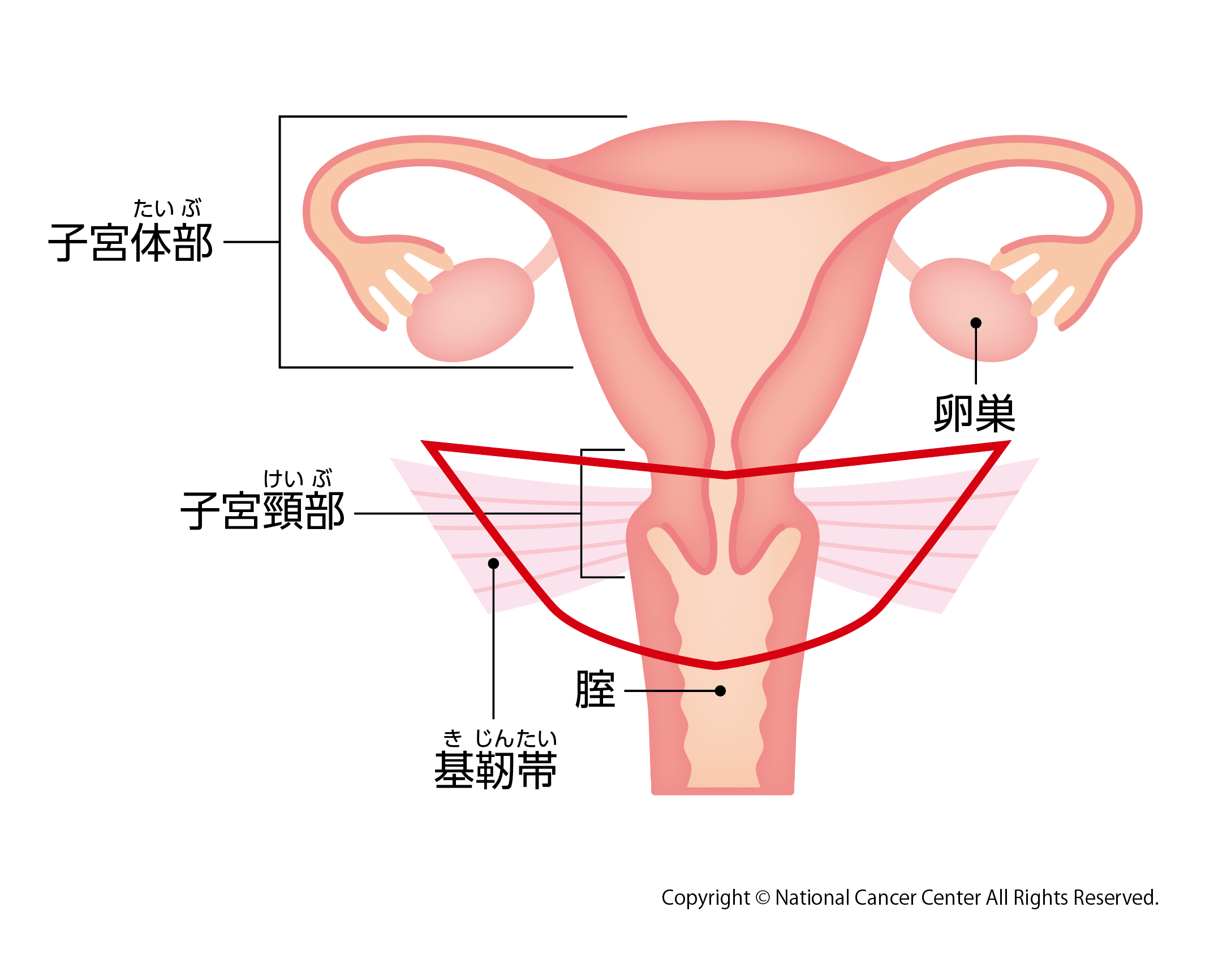 広汎子宮頸部摘出術