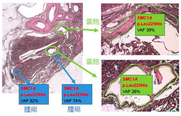 図6 嚢胞の遺伝子変異の画像
