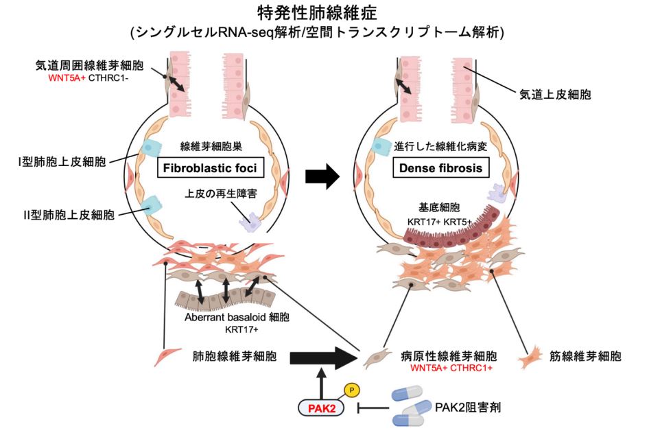 特発性肺線維症の画像