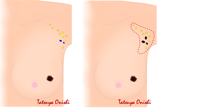 乳房部分6