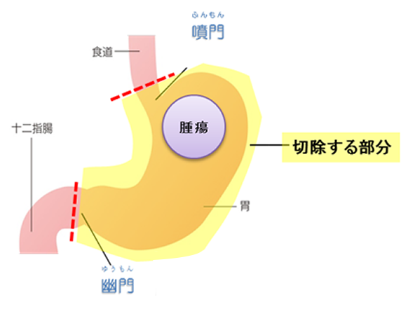 胃全摘術・ルーワイ法再建の画像1