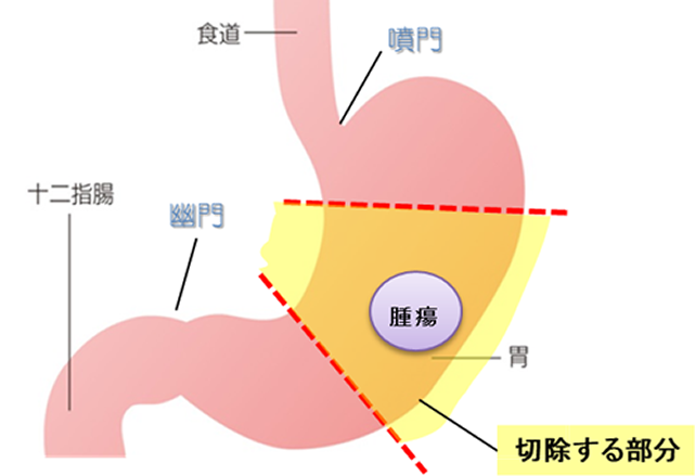 幽門保存胃切除術の画像