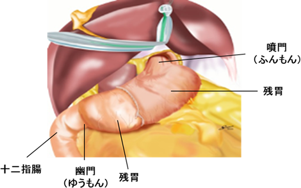 幽門保存胃切除術の画像2