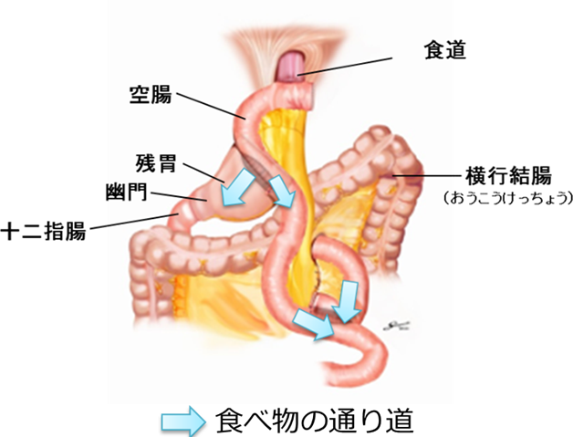 噴門側胃切除・ダブルトラクト法再建の画像