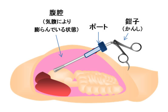 腹腔鏡下手術のイメージ