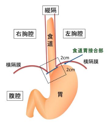 食道側への浸潤が2cm以内の場合の画像