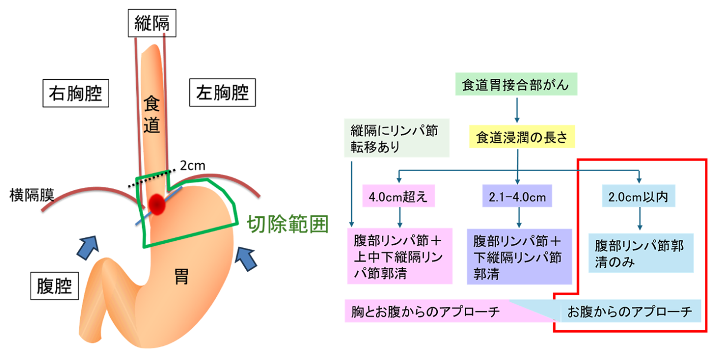 食道側への浸潤が２cm以内の場合の画像