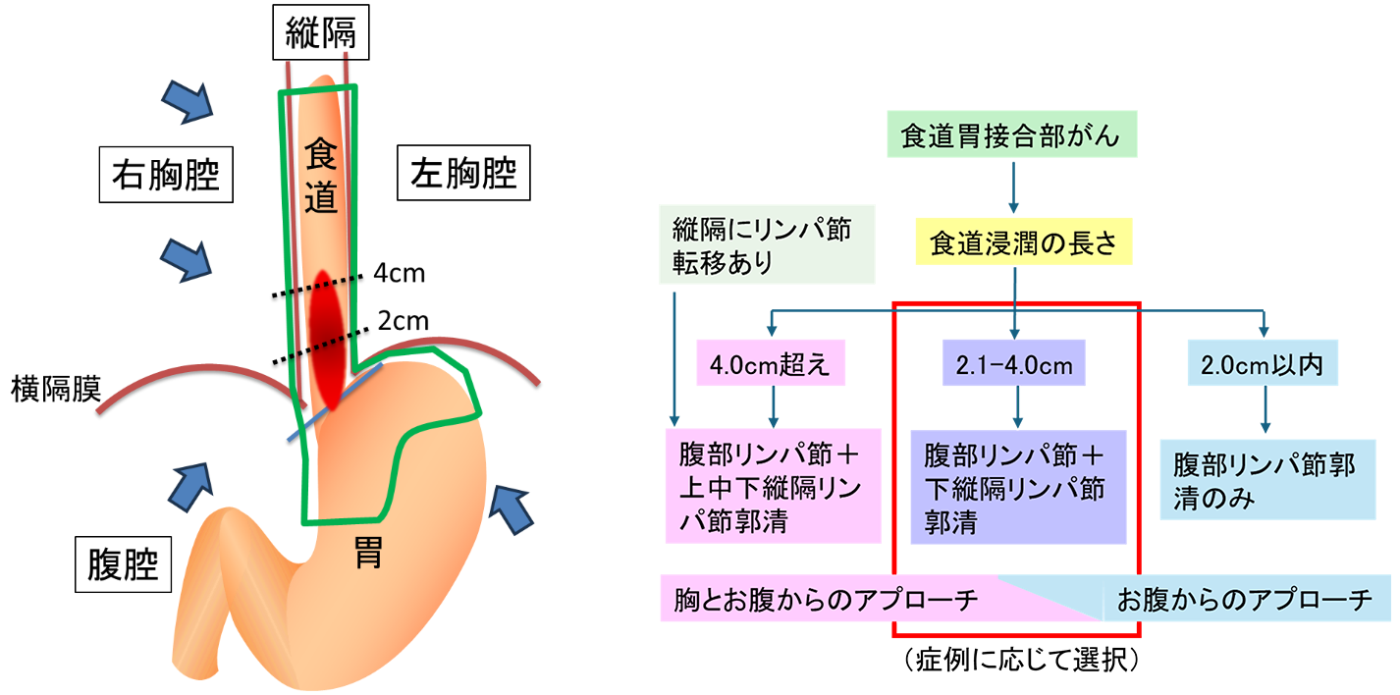 食道側への浸潤が2.1cmから4.0cmの場合の画像