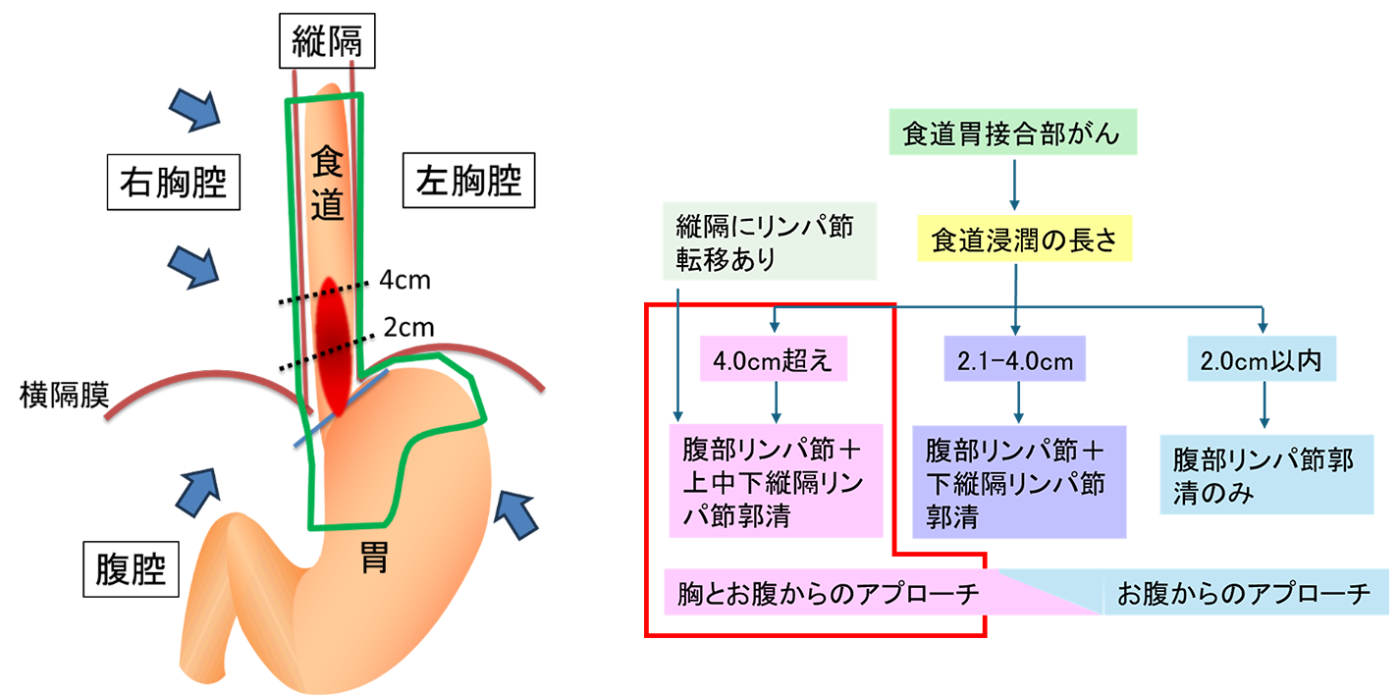 食道側への浸潤が4.0cmを超える場合の画像