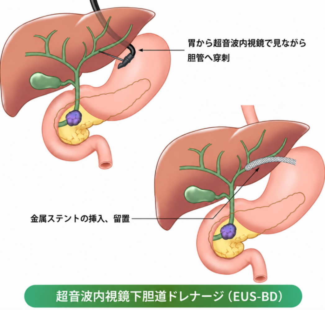 超音波内視鏡下胆道ドレナージ