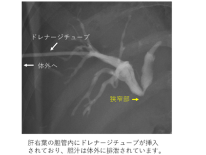 狭窄部