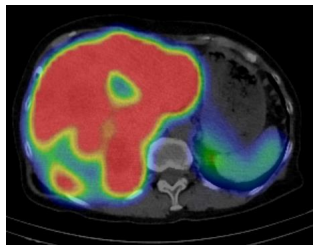 ルタテラ投与直後に撮影したSPECT検査の画像