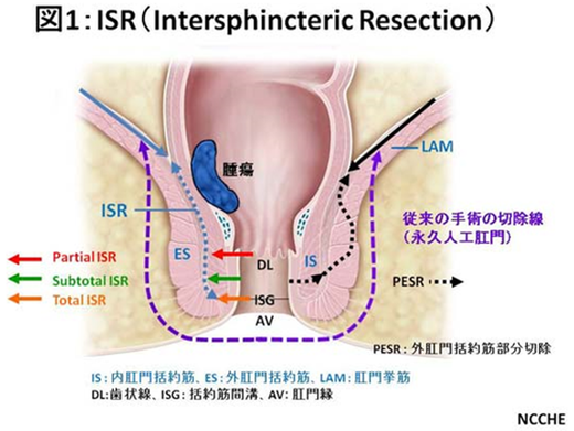 肛門温存手術