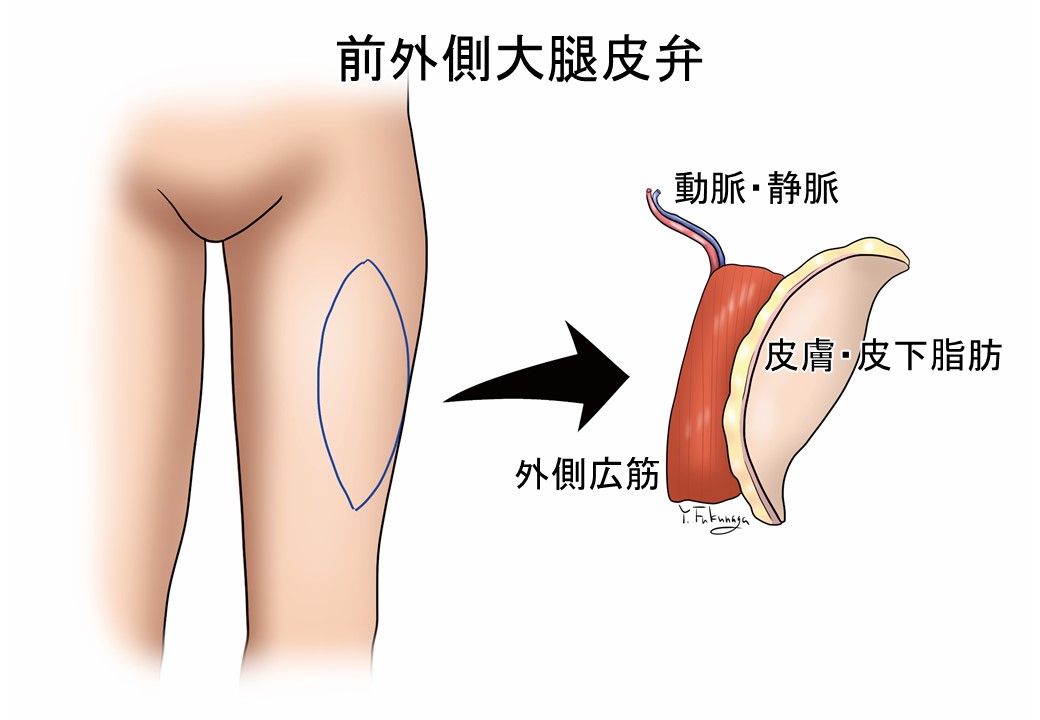 前外側大腿皮弁の画像