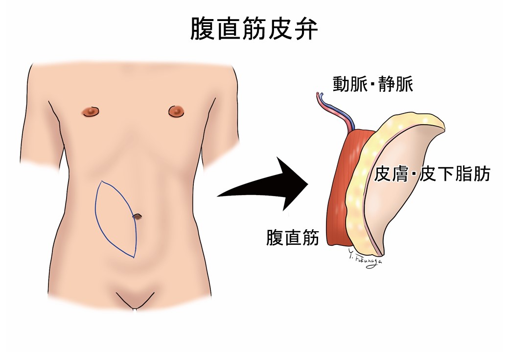 腹直筋皮弁