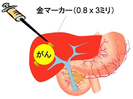 陽子線治療の方法　図