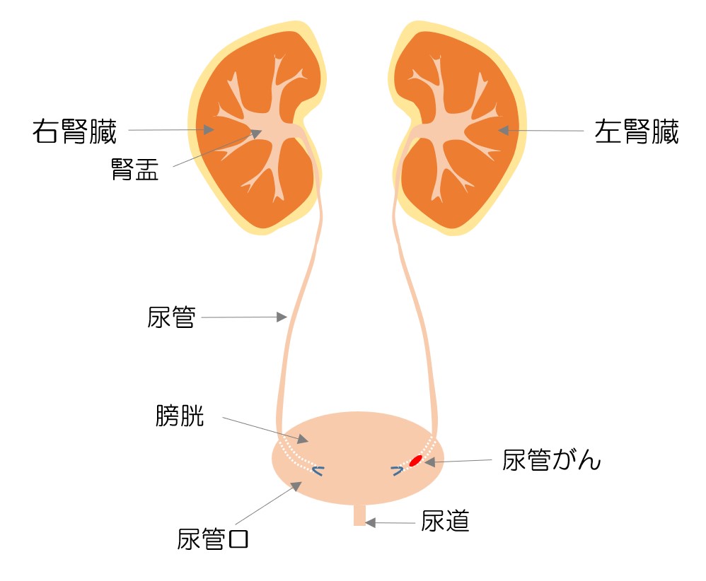 下部尿管がんに対する下部尿管切除および尿管胱新吻合術の画像