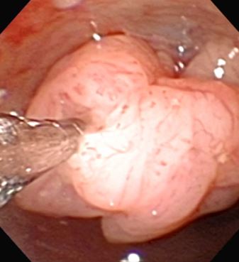 尿管鏡での腎盂腫瘍生検の画像