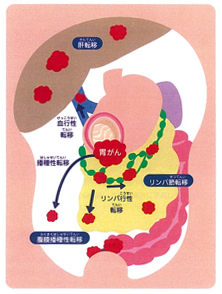 胃がんの転移形式