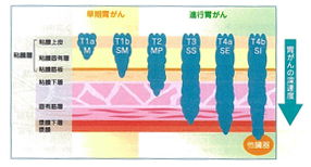 胃がんの深さの分類（1）