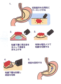 内視鏡的粘膜下層剥離術（ESD）