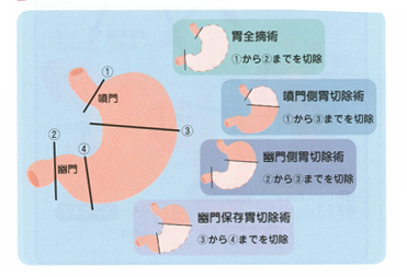 胃の切除範囲