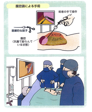 腹腔鏡下胃切除術