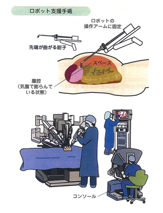 ロボット支援胃切除