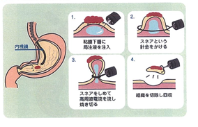 内視鏡的粘膜切除（EMR）