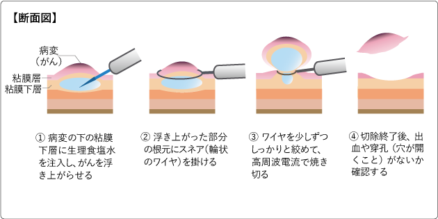 内視鏡的粘膜切除術（EMR）図