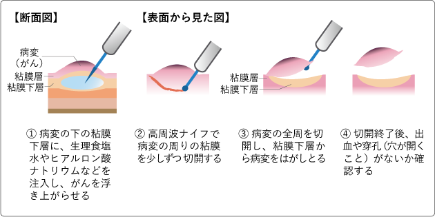 内視鏡的粘膜下層剥離術（ESD）図