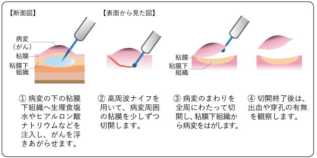 図2 内視鏡的粘膜下層剥離術（ESD）