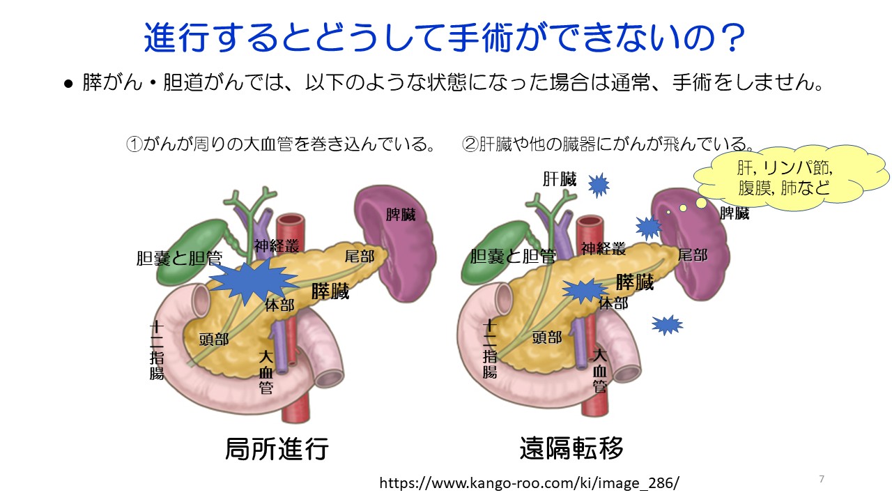 入門編１ 膵がん・胆道がんの診断と治療スライド7