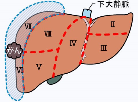 図3c_肝区域切除