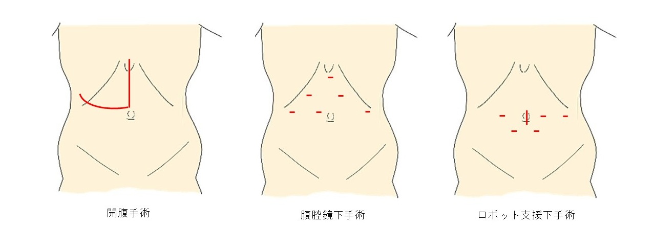 腹腔鏡下・ロボット支援肝切除