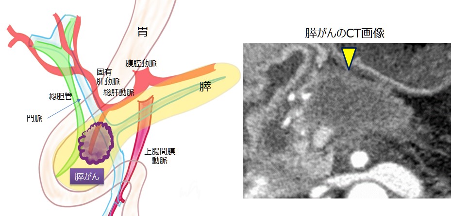 図1_膵がんの特徴・CT画像