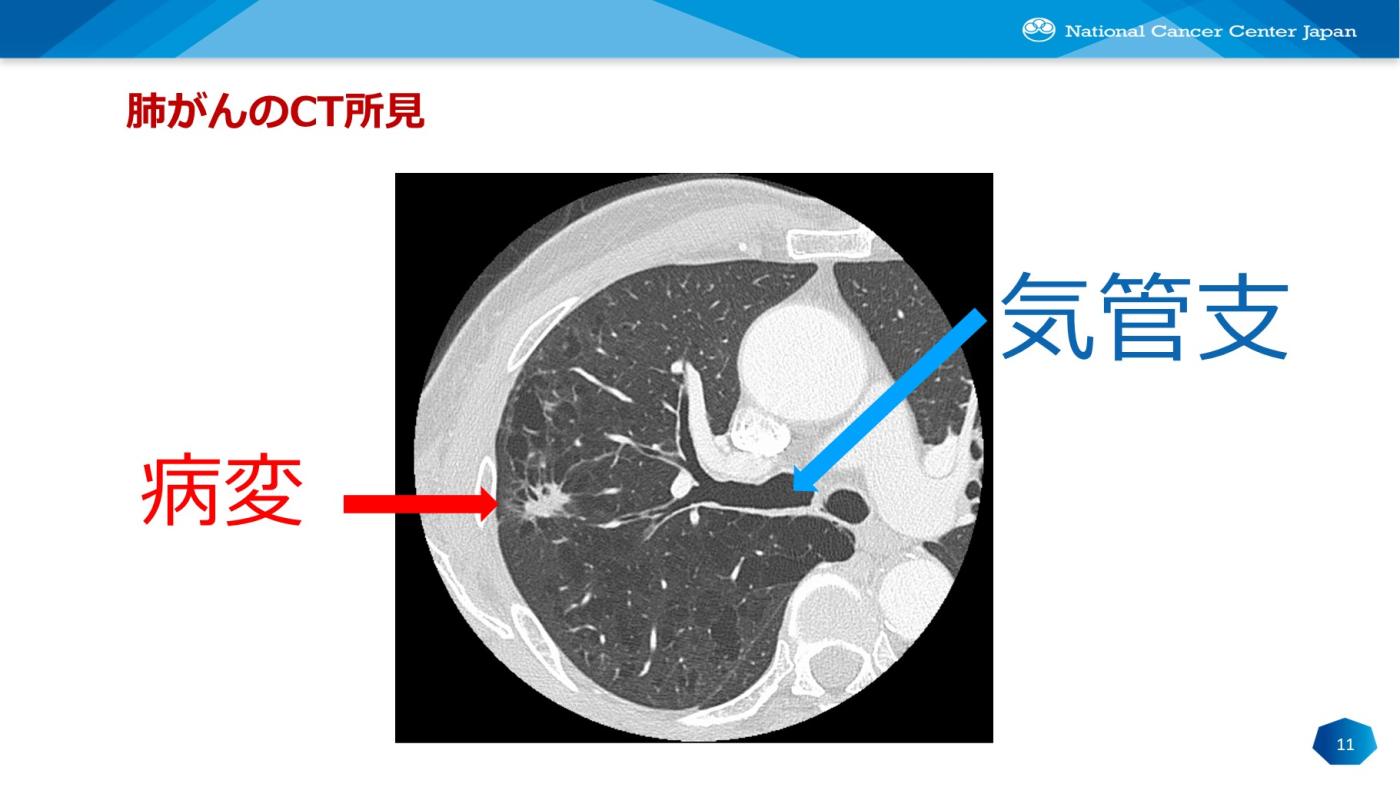 肺がんのCT所見