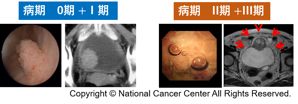 膀胱がん病期.png